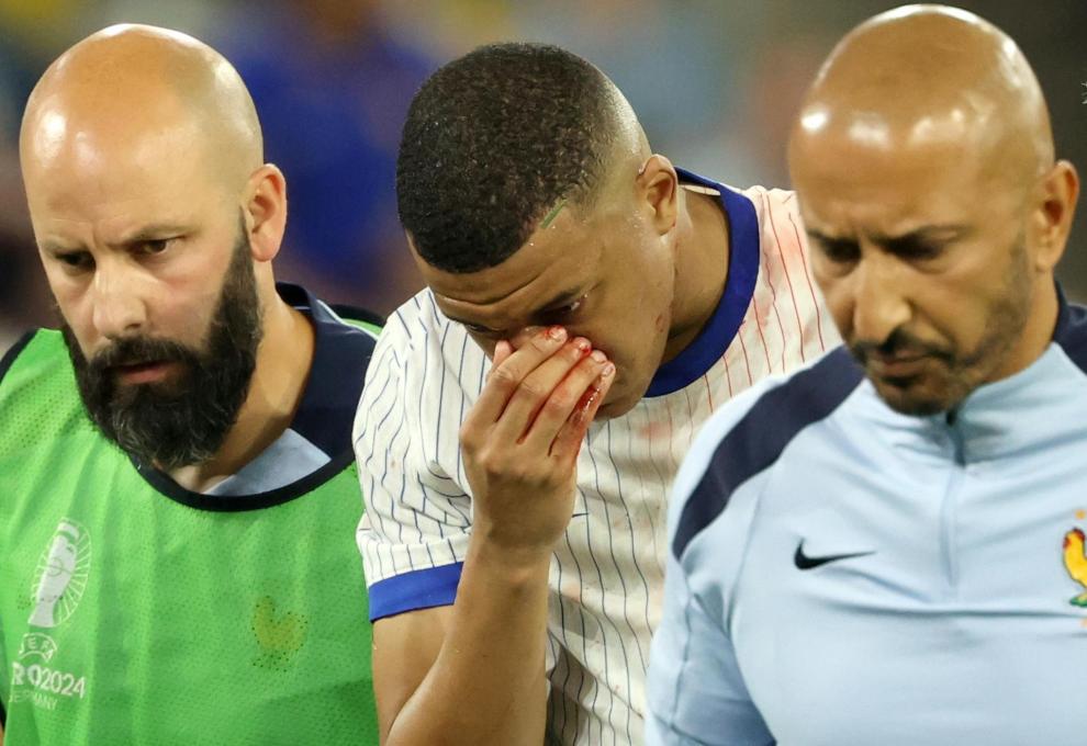 Mbappé sale adolorido tras fracturarse la nariz.